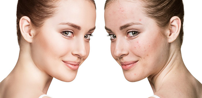 Tratamientos contra el acné